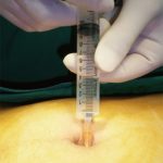 bupivacaine bupivacaine