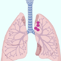 drug-resistant-TB-Note drug-resistant-TB-Note